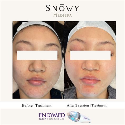 EndyMed 3Deep: Cost, Reviews, Photos .